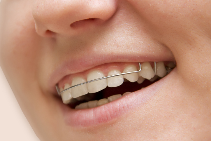 Young Girl Smiling wearing Hawley Retainer