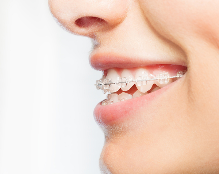 Close Up Of Smiling Woman Wearing Braces