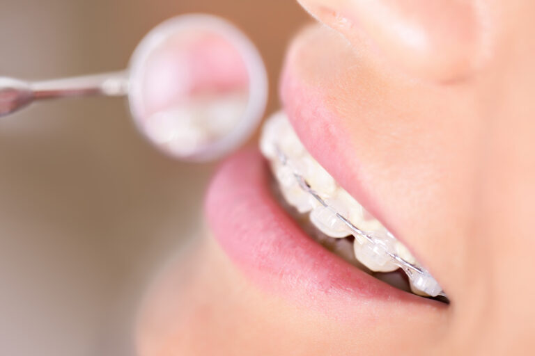 Braces