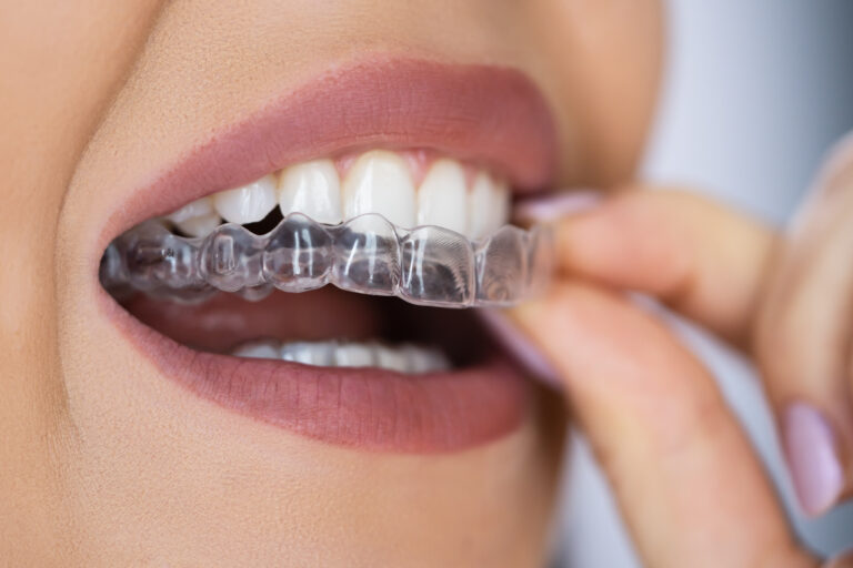 Close Up Of Woman Inserting Clear Aligner Into Mouth