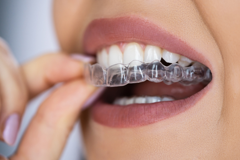 Close Up Of Smiling Woman Wearing Essix Retainer